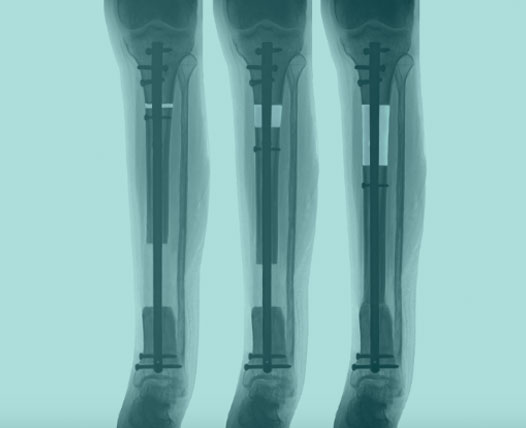 Bone Lengthening